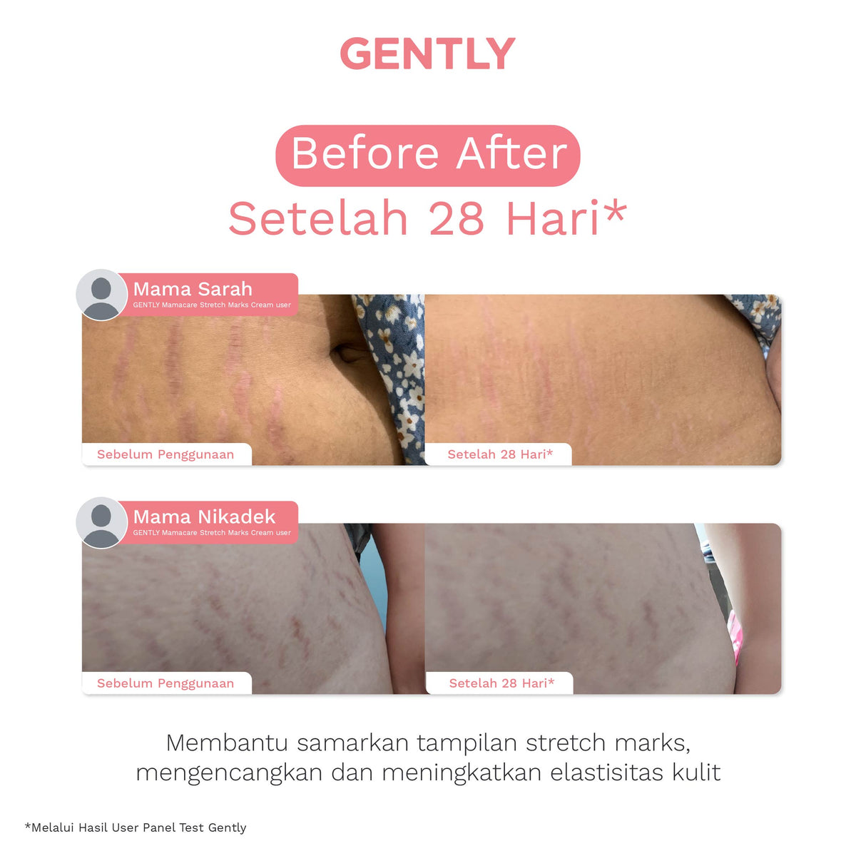 GENTLY Intensive Stretch Marks Cream 40 g | Complex Hydrating Formula  5X Natural Soothing Agent | Skincare Ibu Hamil dan Menyusui Terdaftar BPOM | Cream untuk Menyamarkan Peregangan Kulit dan Membantu Melembapkan