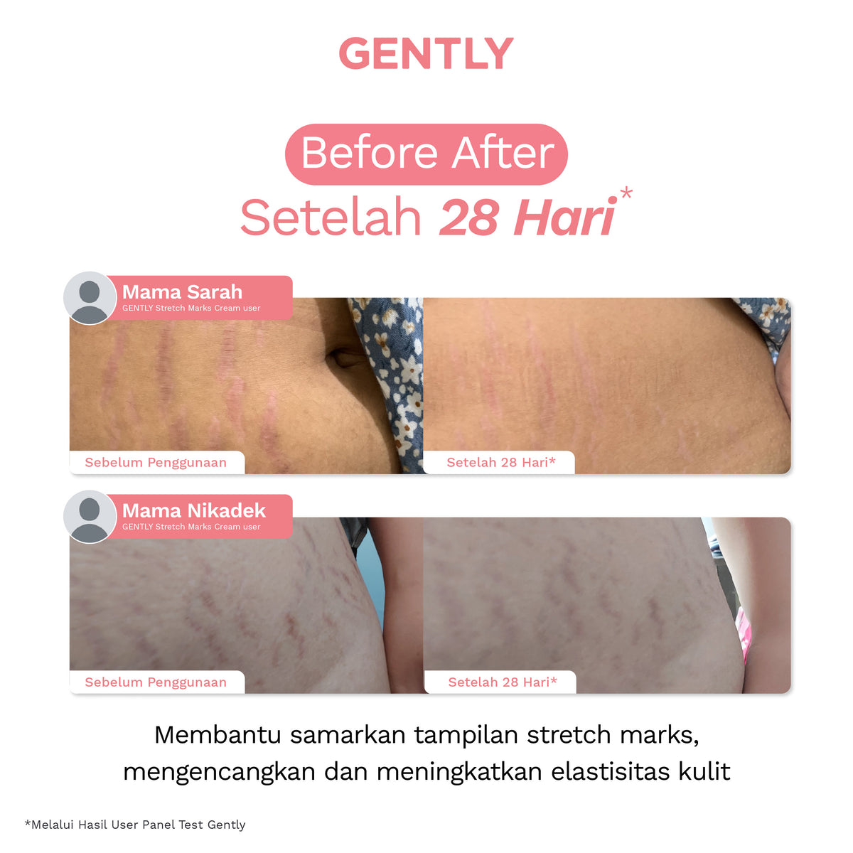 GENTLY Intensive Stretch Marks Cream 100g | Complex Hydrating Formula  5X Natural Soothing Agent | Skincare Ibu Hamil dan Menyusui Terdaftar BPOM | Cream untuk Menyamarkan Peregangan Kulit dan Membantu Melembapkan